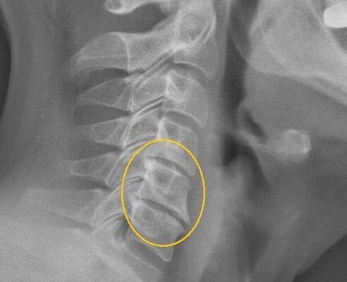 osteochondrosis នៃឆ្អឹងខ្នងមាត់ស្បូននៅលើ X -RAR