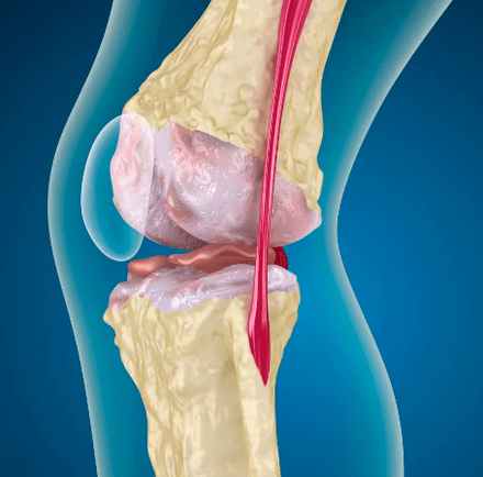Arthrososis នៃសន្លាក់ជង្គង់
