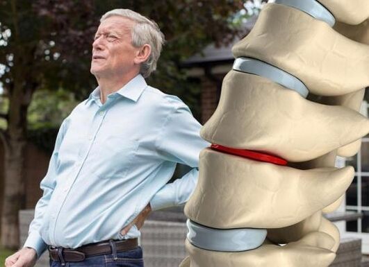 Osteochondrosis ប៉ះពាល់ដល់ឌីស intervertebral និងបណ្តាលឱ្យឈឺខ្នង