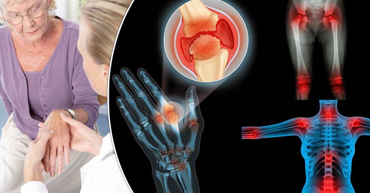 តើ arthrosis គឺជាអ្វី